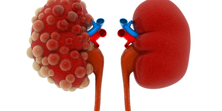 Polikistik böbrek hastalığı yavaş gelişir, her şey hızla değişir