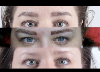 Yüz İfadesinde Yeni Çağ: Micro Brow Implant Teknolojisi İle Estetikte Dönüm Noktası