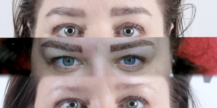 Yüz İfadesinde Yeni Çağ: Micro Brow Implant Teknolojisi İle Estetikte Dönüm Noktası